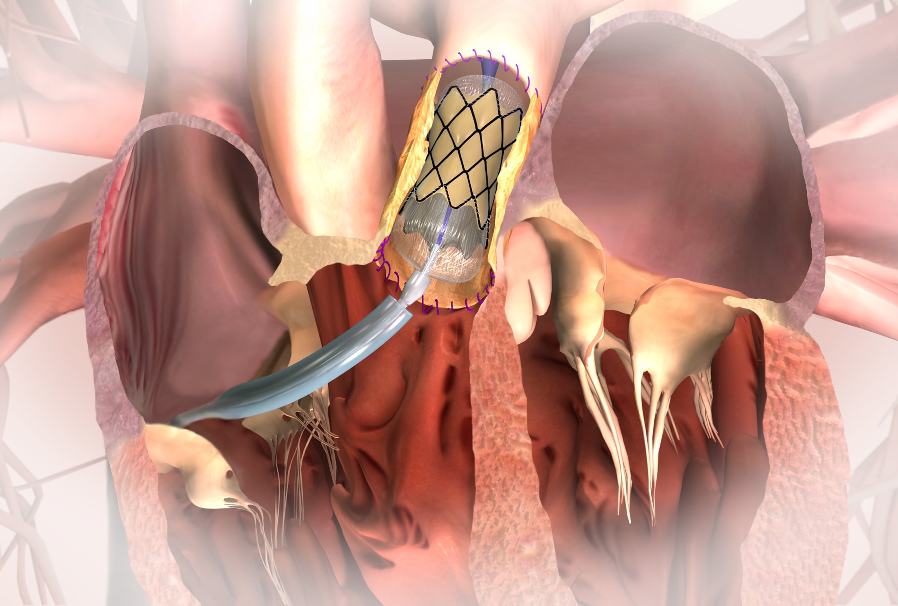 FDA Approves Transcatheter Pulmonary Valve DAIC
